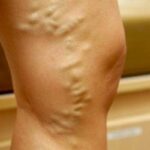 evitar las varices