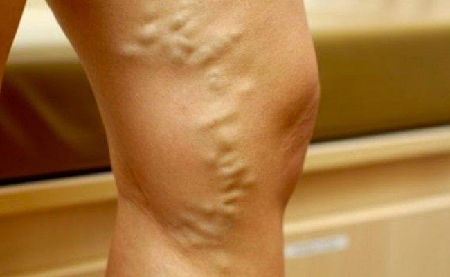 10 consejos para evitar las varices