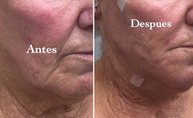 Lifting facial con los nuevos hilos tensores Da Vinci