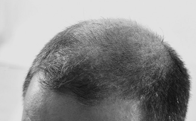 Qué es la alopecia