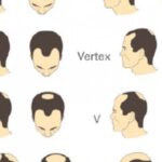 tipos de alopecia