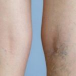 eliminar varices