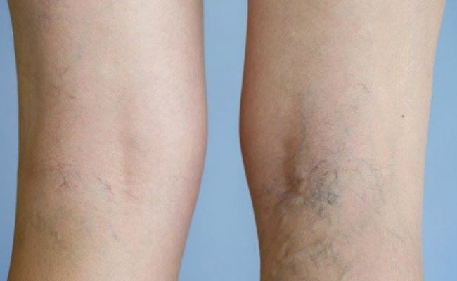 Cómo puedo eliminar mis varices y prevenirlas de forma definitiva