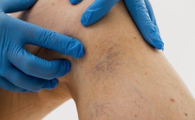 Tipología y causas de las varices