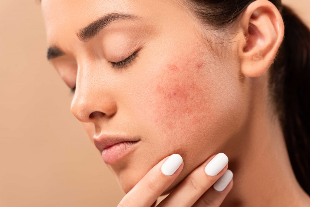 Cómo eliminar las cicatrices del acné