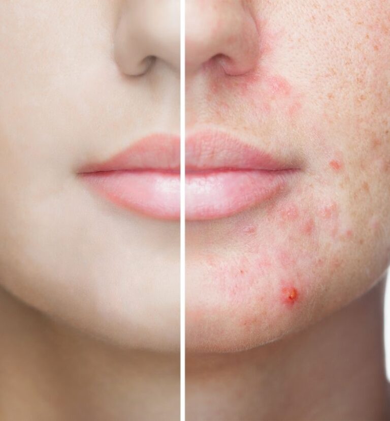 Best acne treatments in 2022