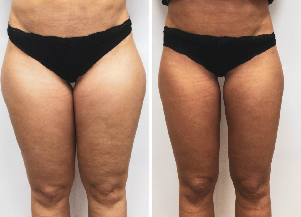 Antes y despues Velashape III