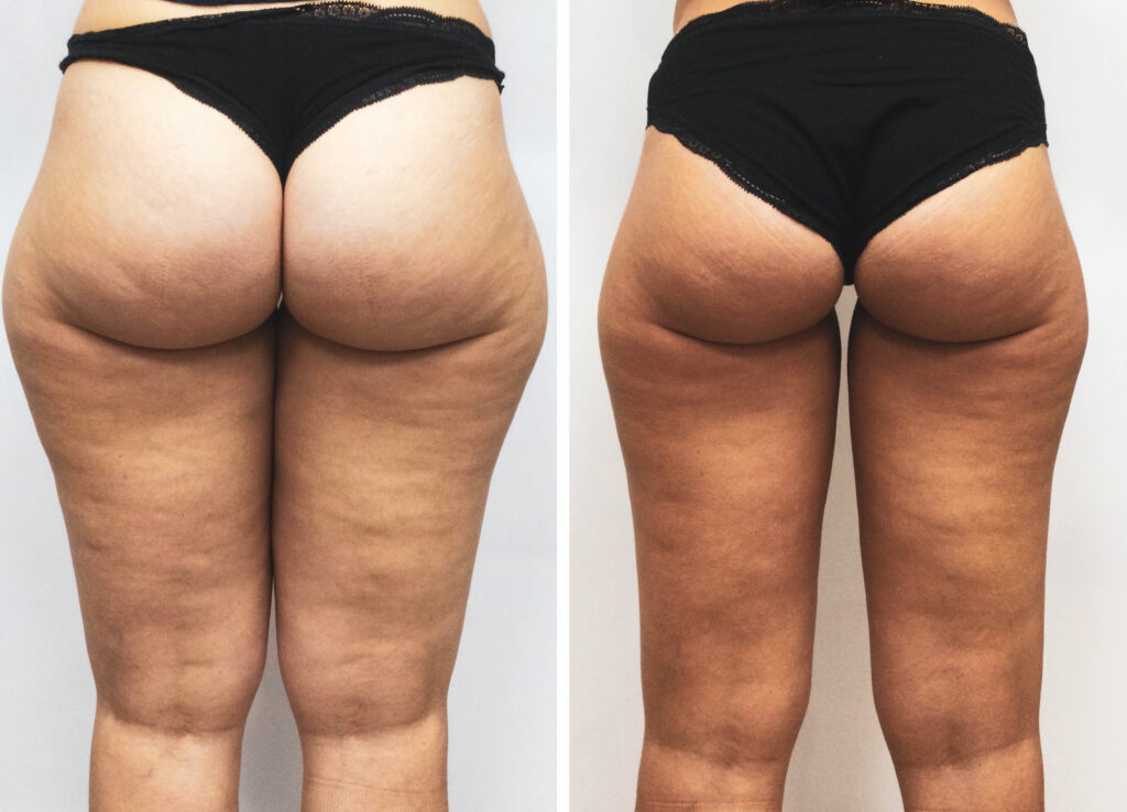Antes y despues Velashape III