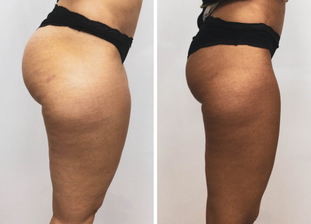 Antes y despues Velashape III