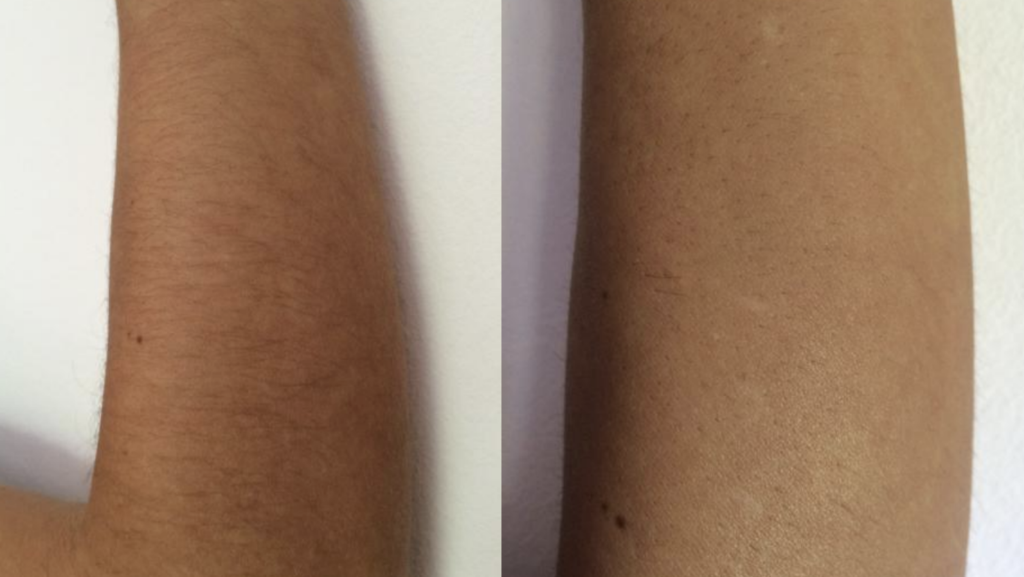 Antes y despues depilacion corporal
