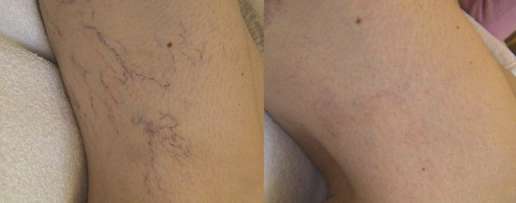 Láser MeDioStar Antes y Despues