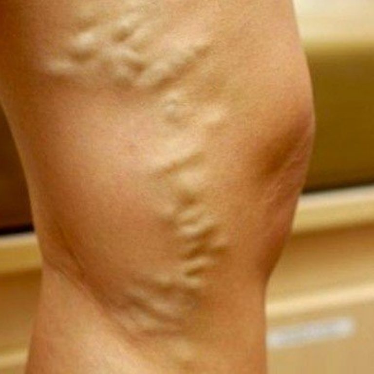 evitar las varices