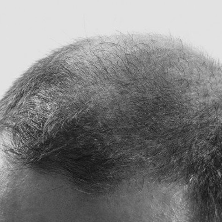 que es alopecia