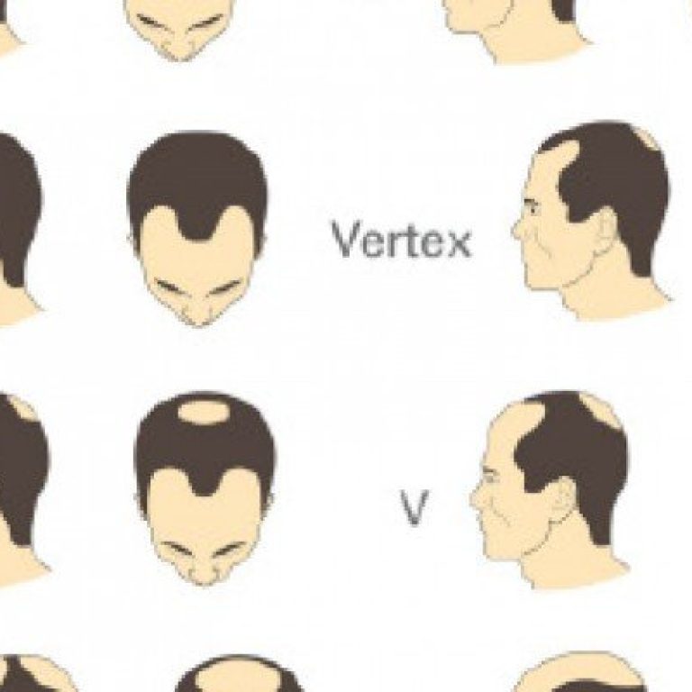 tipos de alopecia
