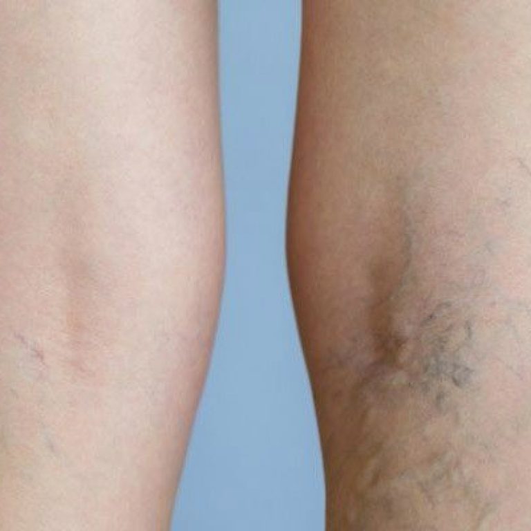 eliminar varices