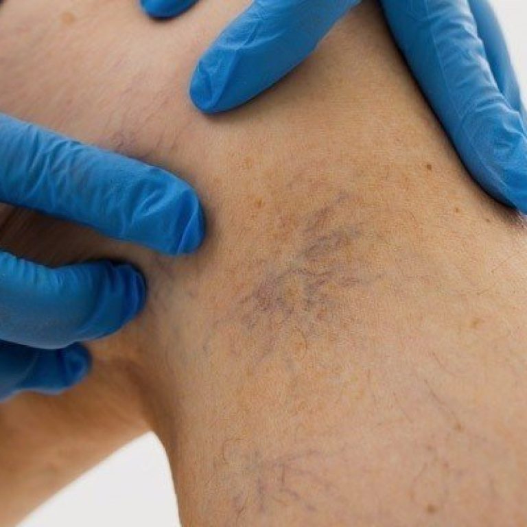 causas de las varices